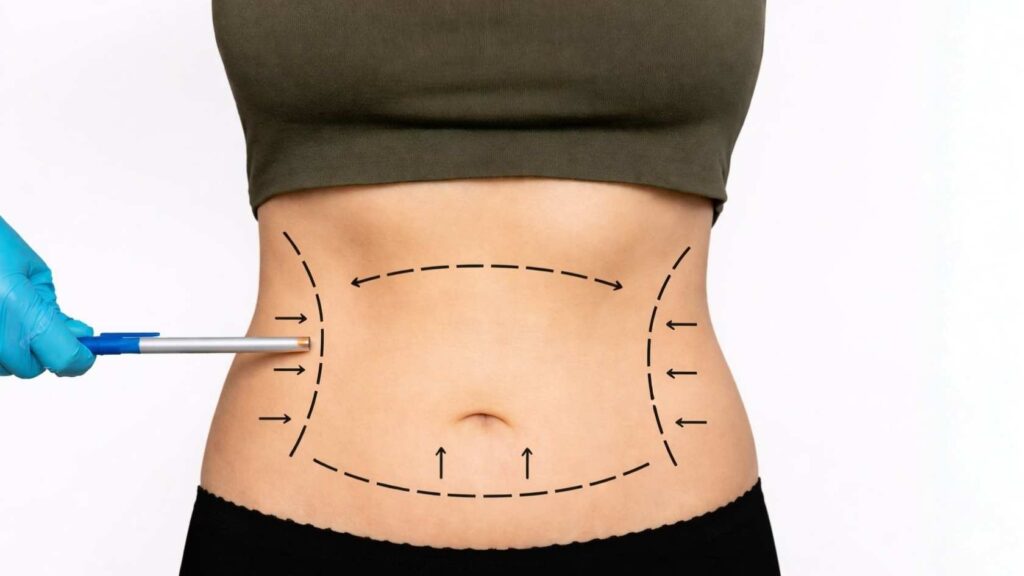 paitent with markers before liposuction operation