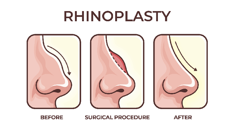 Rhinoplasty Diagram