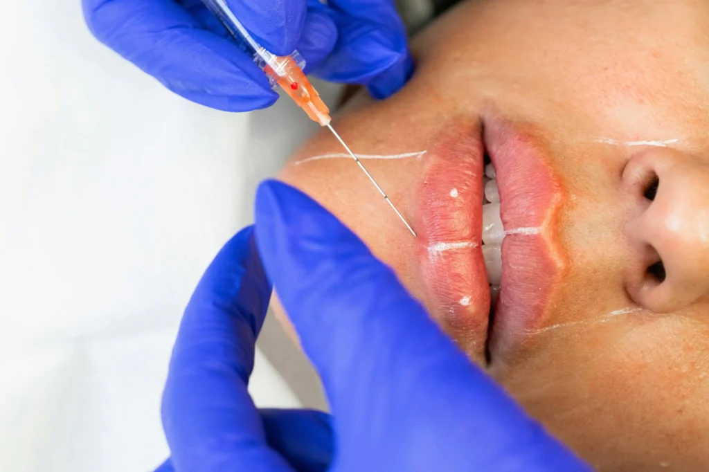 woman receiving a injection to her lips