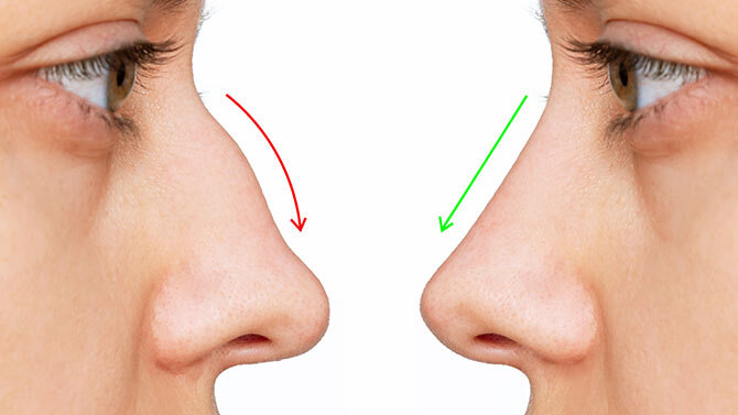 Woman with Rhinoplasty treatment