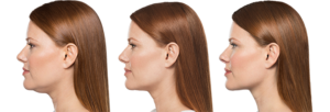 Non-Surgical Submental Treatments