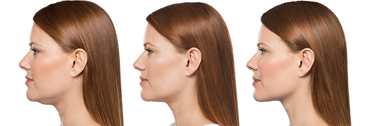Non-Surgical Submental Treatments