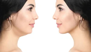 Chin Liposuction: